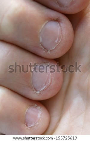 Very chewed and bitten fingernails in bad condition