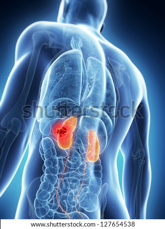 3D rendered illustration of the male kidneys cancer 3D rendered illustration of the male kidneys cancer
