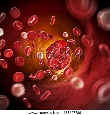 3d rendered illustration of arteriosklerosis - stock photo