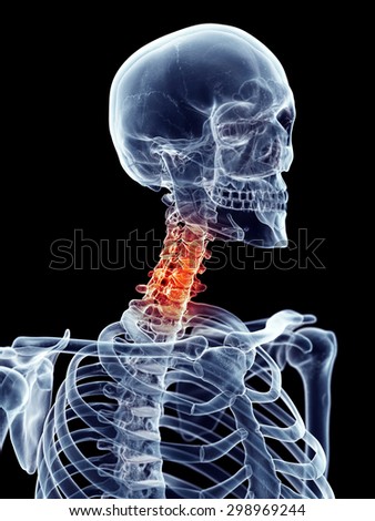 medically accurate illustration - painful neck