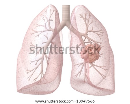 Cartoon Lung Cancer