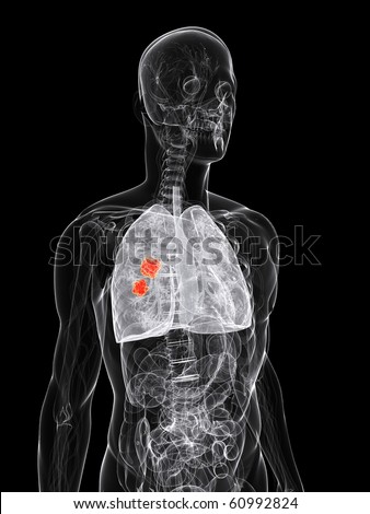 x rays of lung cancer. stock photo : x-ray - anatomy