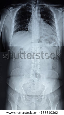 X-ray of the spinal column