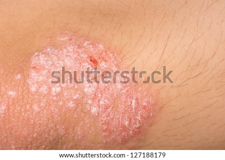 psoriasis skin disorder on an elbow