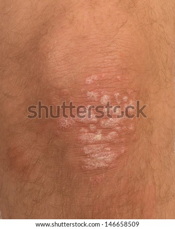 psoriasis skin disorder on a knee