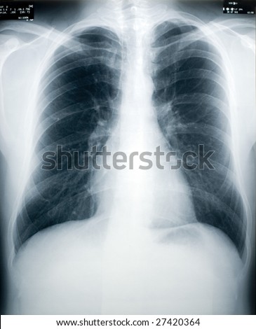 tuberculosis x ray. stock photo : An x-ray of a