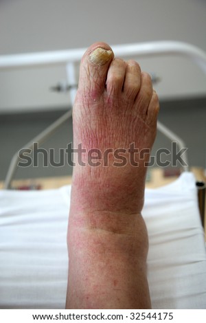 illness foot