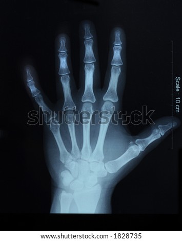 X Ray Hand. stock photo : x-ray film of