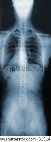 This is an X-ray of the whole torso