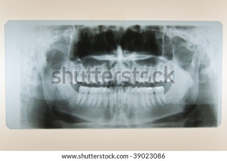 Close-up shot of dental x-ray of human teeth