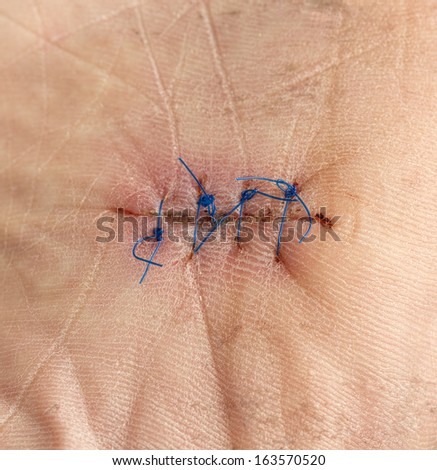 Close up image of sutures on sole of foot