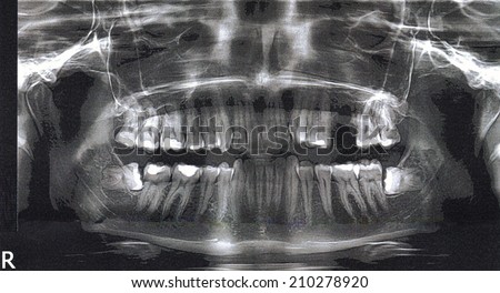 X-ray of a jaw