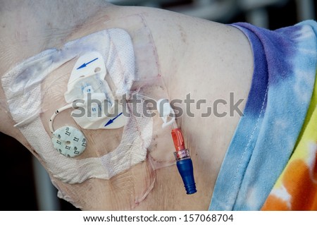 Peripherally Inserted Central Catheter better known as a PICC line