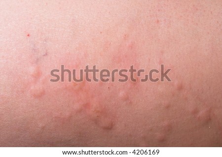Hives - Severe Allergic Reaction