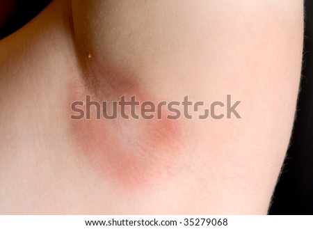 stock photo Yeast Infection in an Armpit Save to a lightbox 