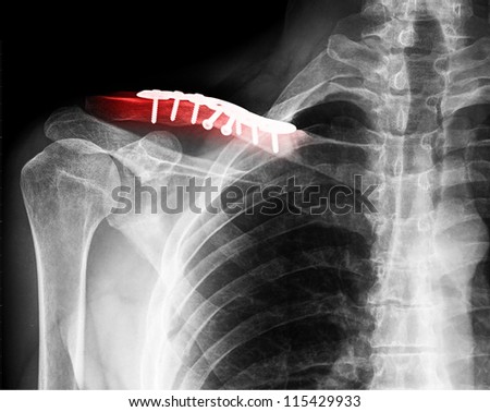 X- ray of collarbone