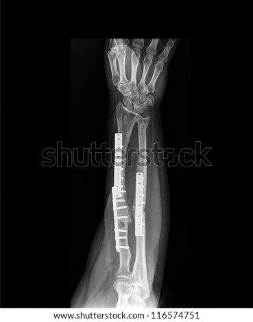 Arm  x-ray