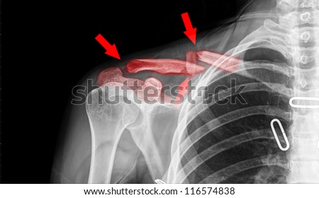 X- ray of collarbone