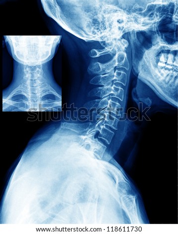x-ray of neck