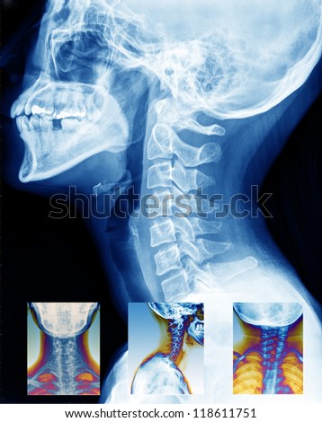 x-ray of neck