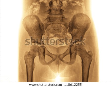 x-ray of hip and pelvis