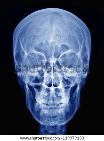 X-ray picture of the skull