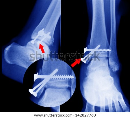 x ray of fractures bone