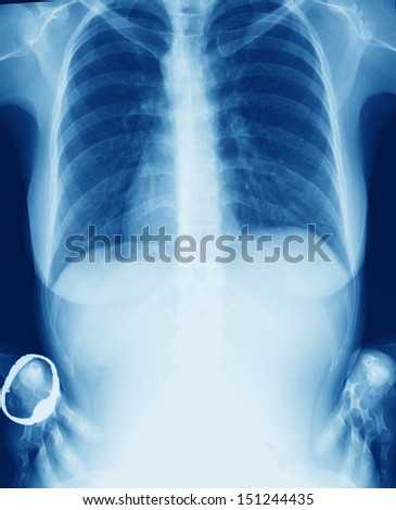X-Ray Image Of Young Woman Chest for a medical diagnosis