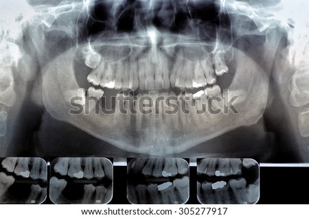 Dental radiography (ortopanoramica) Digital x-ray teeth scan. Panoramic negative image facial of adult male.