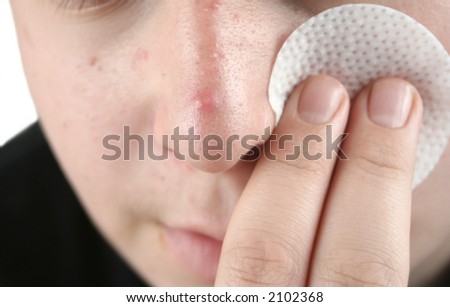 boy with cleansing pad trying to clear up his acne