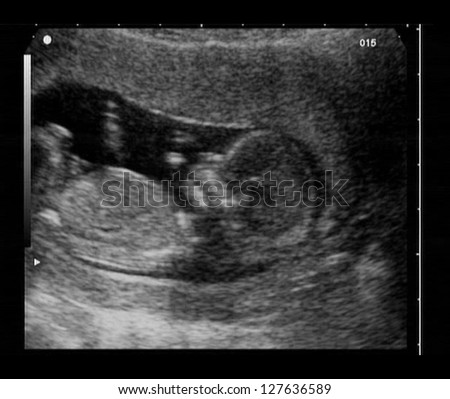 ultrasound fetus at 12 weeks