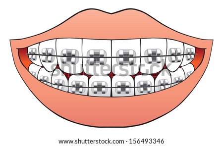 Teeth with braces Teeth with braces