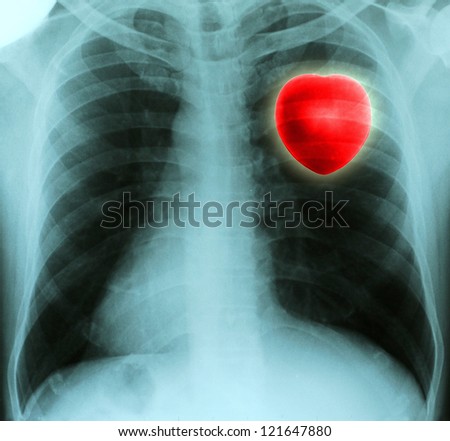Red heart in thorax on x-ray film