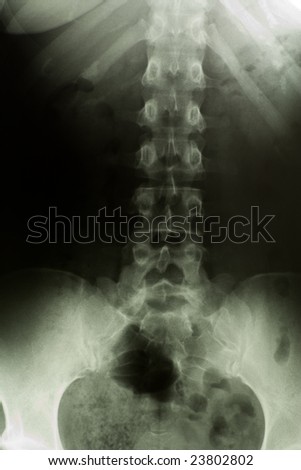 Frontal X-ray of the lumbar spine