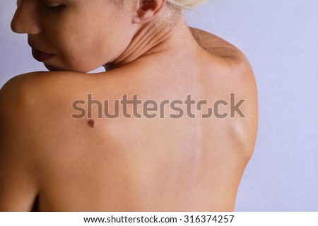 Young woman looking at birthmark on her back, skin. Checking benign moles. Skin tags removal