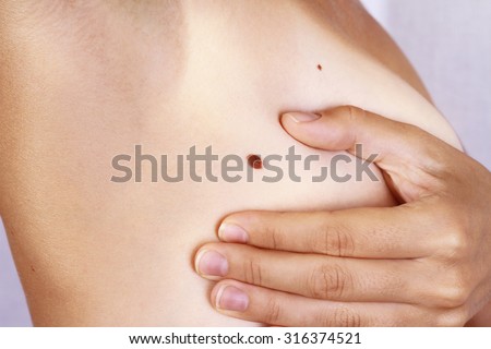 Young woman holding her arms up and showing underarms,  armpit. Birthmark on skin. Checking benign moles