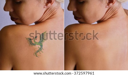 Laser tattoo removal befor and after. Beautiful young woman with tattoo on her back