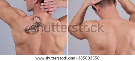 Laser tattoo removal before and after. Attractive Man with tattoo on his back skin