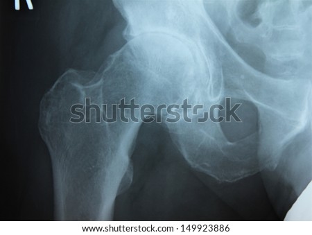 Severe Osteoarthritis of the Right Hip in a 58 year old male. The neck of the femur is thickened along with a narrow joint space.