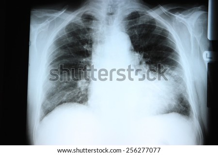 Chest X-ray showing a large infiltrate in the lingular segment of the left lung. Pneumonia.