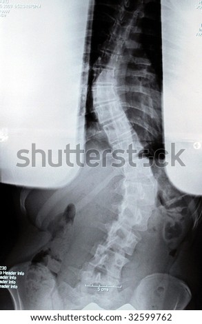 Scoliosis- Lateral Curvature of the Spine