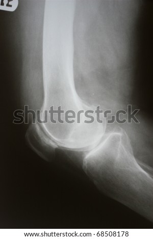 Xray Right Knee with Degenerative Joint Disease, narrowing of the Femoropatella Joint and an adjacent Osteophyte formation