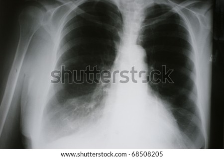 Xray of Chronic Obstructive Pulmonary Disease, COPD, with Right Middle Lobe Atelectasis secondary to lung cancer, hyperinflated lungs and Artherosclerotic calcifications of the thoracic aorta