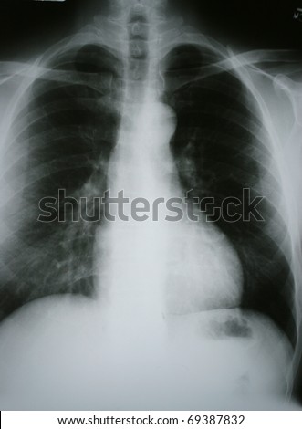 Xray of Chronic Obstructive Pulmonary Disease (COPD) with Lung Cancer in the Right Lung