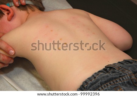 Pediatric Allergy Skin Test