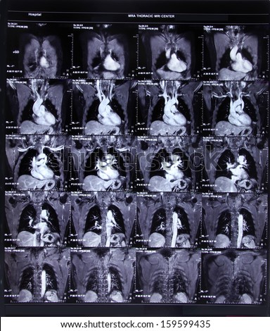 Image of CT scan chest and heart