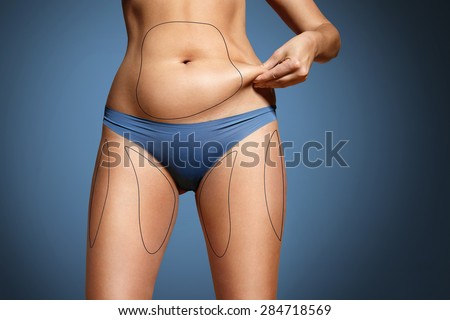woman pinched her fat on body. Body with marked zones for liposuction