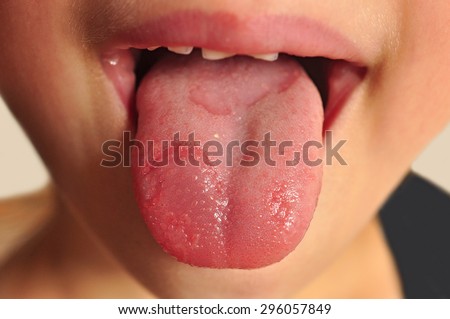 Human tongue stick ed out with infection.
