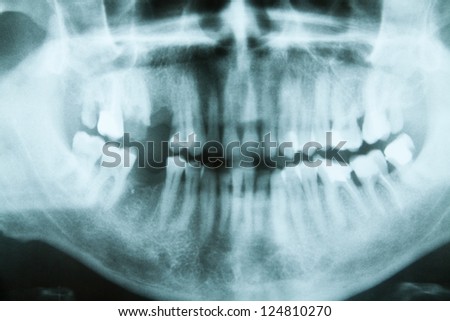 Panoramic dental X-Ray, all teeth in view