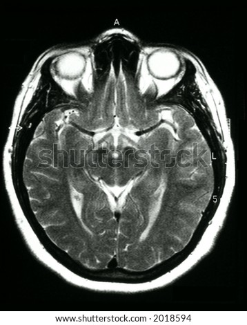 An MRI (Magnetic Resonance Image) of the brain